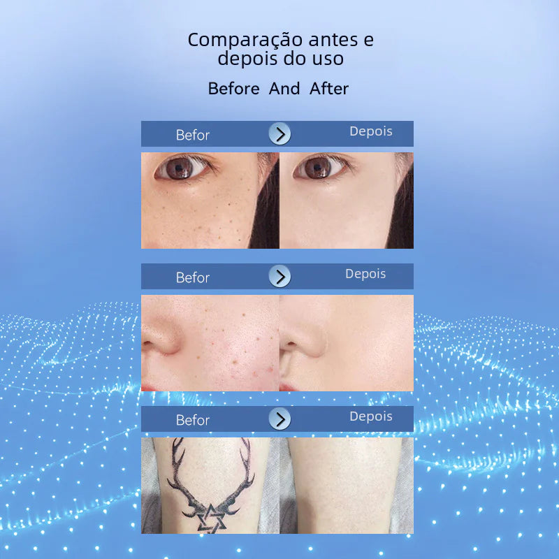 Beauty Laser Pen for Mole and Spot Removal