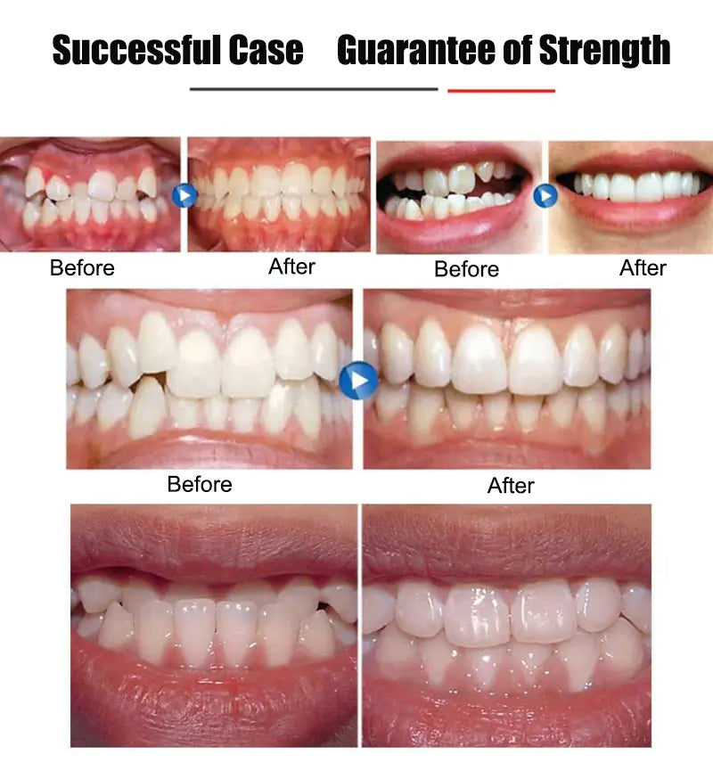 Invisible Teeth Aligners for Adults - Nighttime Use - Joomcy