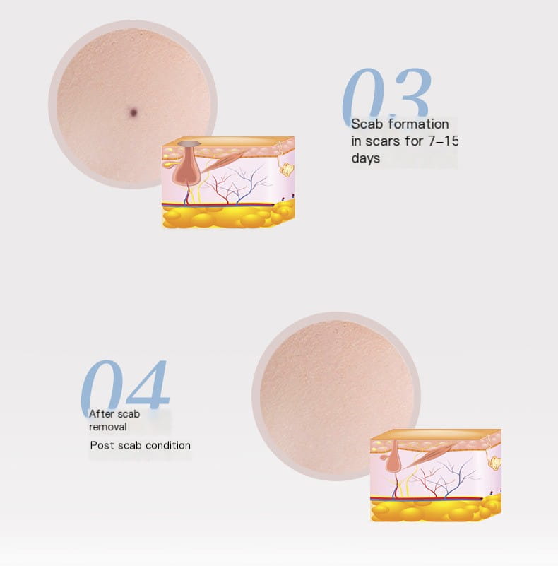 Beauty Mole Pen Image 7