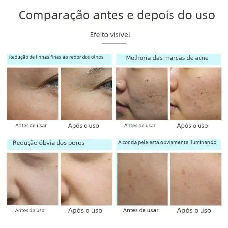 Before-and-after skin treatment results showcasing visible improvements in fine lines, acne scars, pore size reduction, and overall skin brightness.
