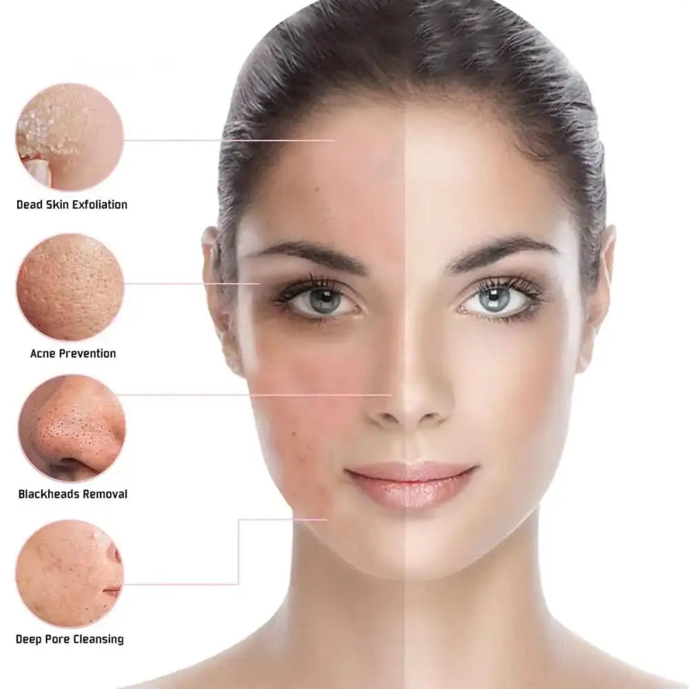 A woman’s face split down the middle, showcasing a side-by-side comparison of skin with visible acne and blackheads on one half versus clear, smooth skin on the other.